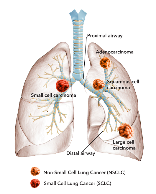 Where NSCLC & SCLC Begin