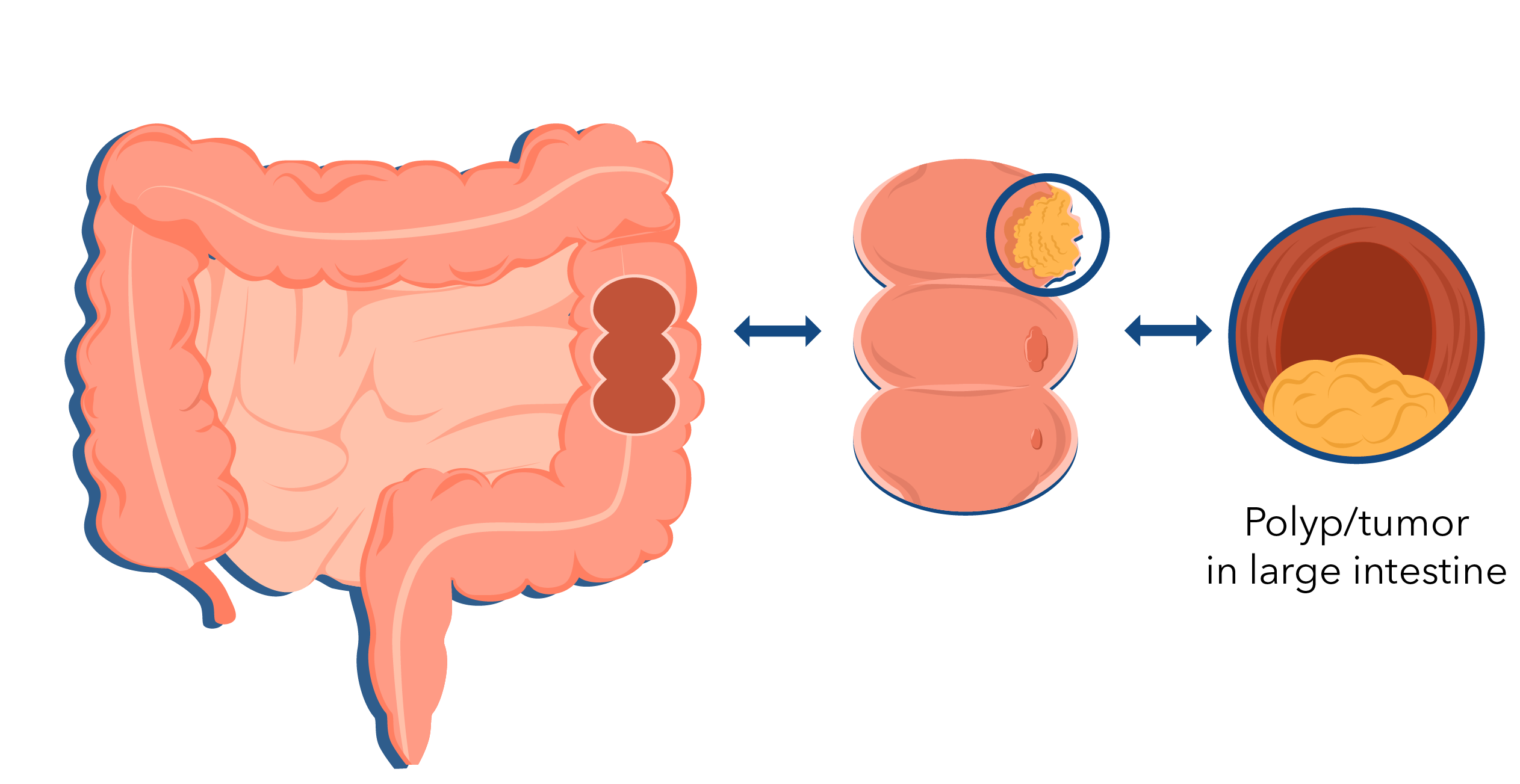 Tumor in large intestine